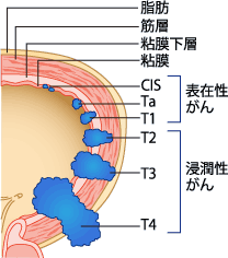 膀胱がんの深達度