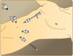腹腔鏡下膀胱全摘術（イメージ図）