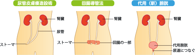 尿路変更の種類