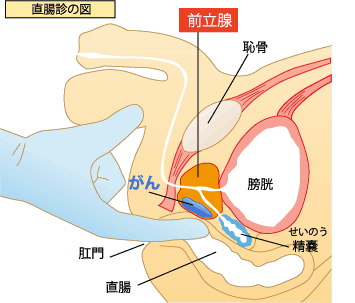 直腸診の図