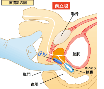 前立腺がん【泌尿器科疾患について】 - 東京慈恵会医科大学 泌尿器科