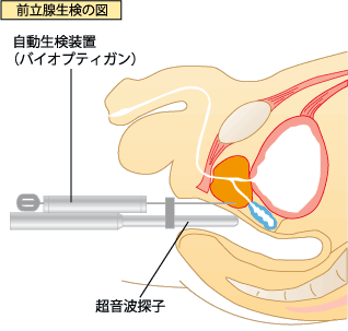 前立腺生検の図