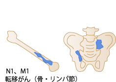 転移がん