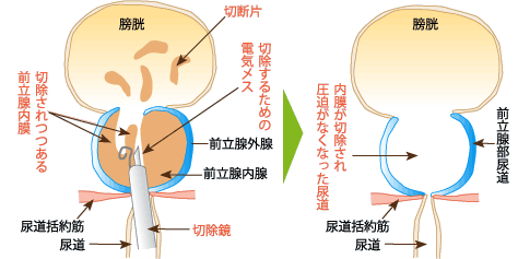 経尿道的前立腺切除術（TURP）とは