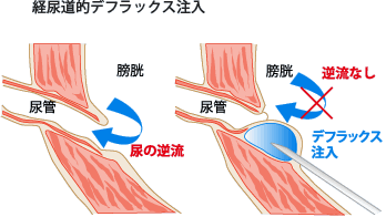 経尿道的デフラックス注入