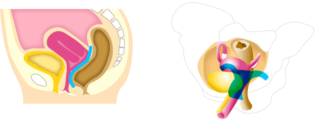 直腸瘤に対する後膣壁メッシュ固定術